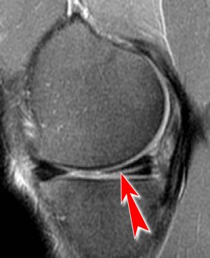 image IRM d'une déchirure méniscale