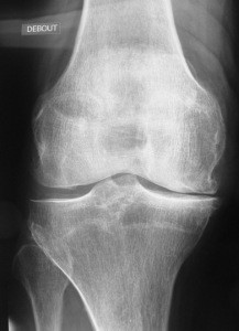 Arthrose du genou prédominant sur l'intérieur: arthrose fémoro-tibiale interne