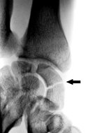 fracture_scaphoide_blanc