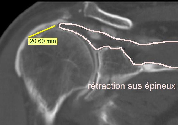 Rupture Transfixiante Du Tendon Supra épineux Maladie Professionnelle