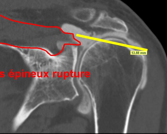 Rupture Transfixiante Du Tendon Supra épineux Maladie Professionnelle