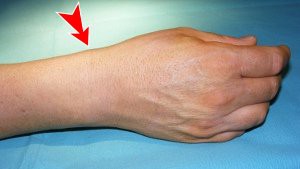Aspect caractéristique de la tendinite de De Quervain : tuméfaction sous cutanée radiale, sur le côté du poignet traduisant de l'inflammation des tendons