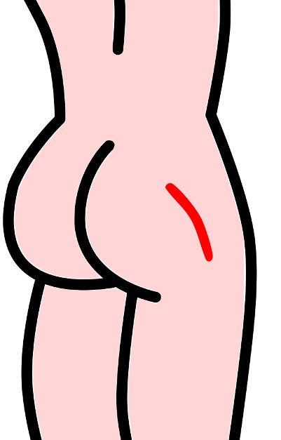 Figure 5.2 – Illustration de la cicatrice de l’opération de la hanche