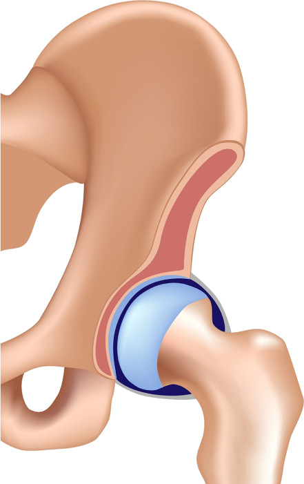 Figure 5.1 – Coxarthrose et PTH